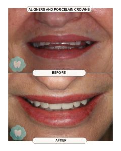 Porcelain Veneers and aligners before and after 1