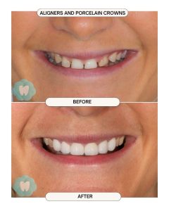 Porcelain Veneers and aligners before and after 2
